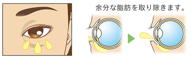 同業の美人女医さんの下眼瞼脱脂を行いました