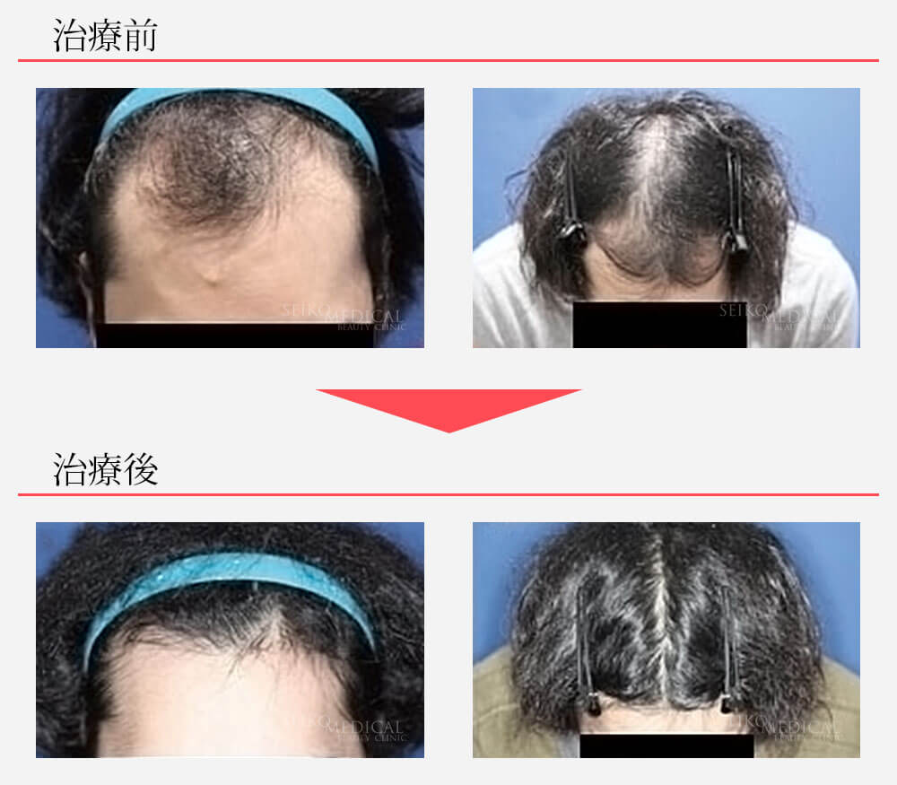 ヘアリバイバル ロゲインフォーム