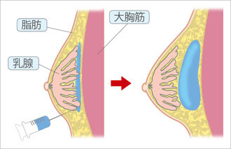 豊胸ヒアルロン酸注入