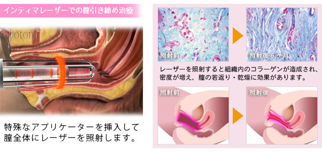 インティマレーザー膣の引き締め治療