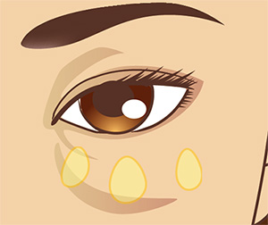 下眼瞼の脂肪除去の症例解説（目の下のくま）