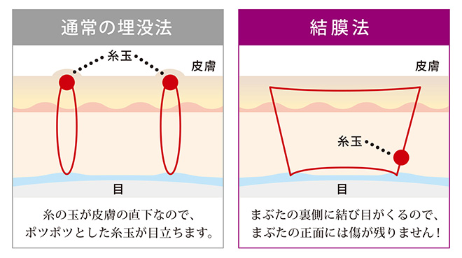 結膜法