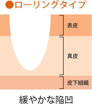 ローリングタイプ 緩やかな陥凹