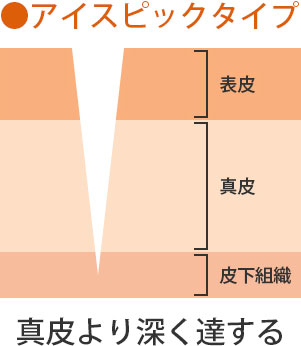 アイスピックタイプ 真皮より深く達する