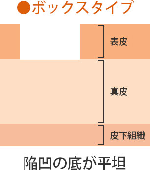 ボックスタイプ 陥凹の底が平坦