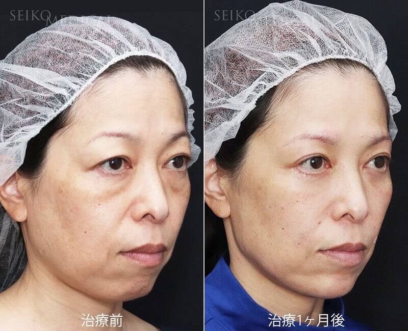 症例 目元とフェイスラインの劇的かつ無理のない自然な若返り