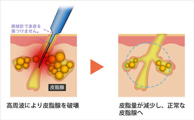 高周波により皮脂腺を破壊 皮脂量が減少し、正常な皮脂腺へ 絶縁針で表皮を傷つけません。