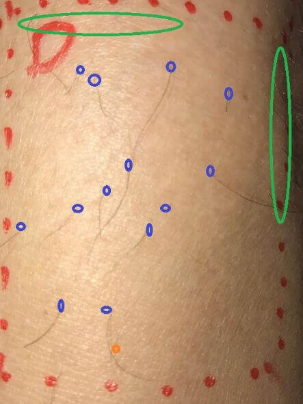 男性のすね毛の脱毛効果を自ら検証！比べてみました。