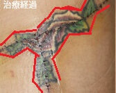 刺青切除と算数の図形問題は似ている？