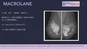 マクロレーン注入後の乳がん？