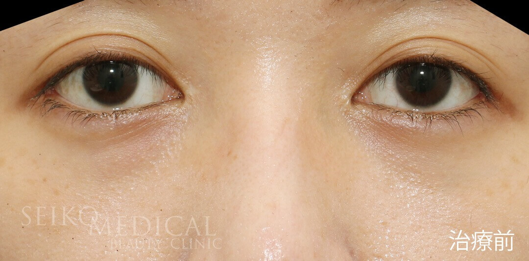３０代女性、たれ目形成術(下眼瞼下制術、グラマラスライン）の直後の症例解説