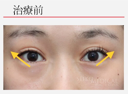 【たれ目形成術の症例解説】自然な形でしっかりと引き下げています。