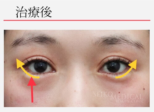 【たれ目形成術の症例解説】自然な形でしっかりと引き下げています。