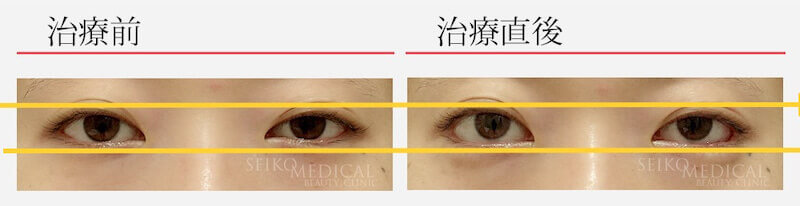 【たれ目形成術（グラマラスライン）の症例解説】左右差を整える形で行った症例