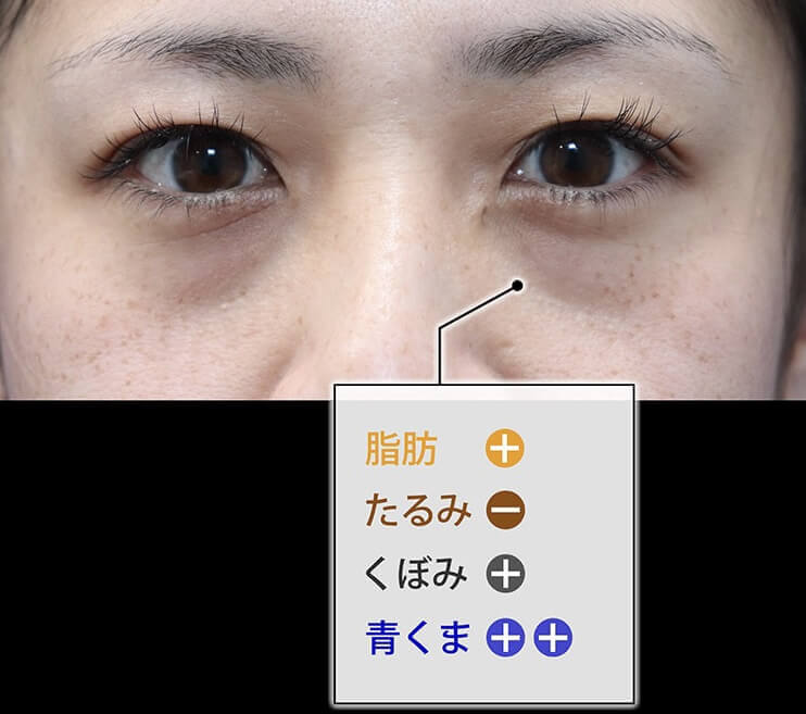 【下眼瞼のクマ、たるみ】脱脂？ハムラ法？裏ハムラ法？脂肪注入？どの治療方法が適しているか