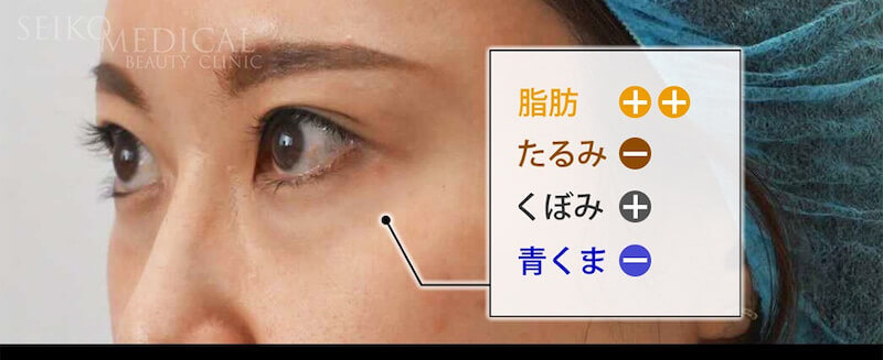 【下眼瞼のクマ、たるみ】脱脂？ハムラ法？裏ハムラ法？脂肪注入？どの治療方法が適しているか