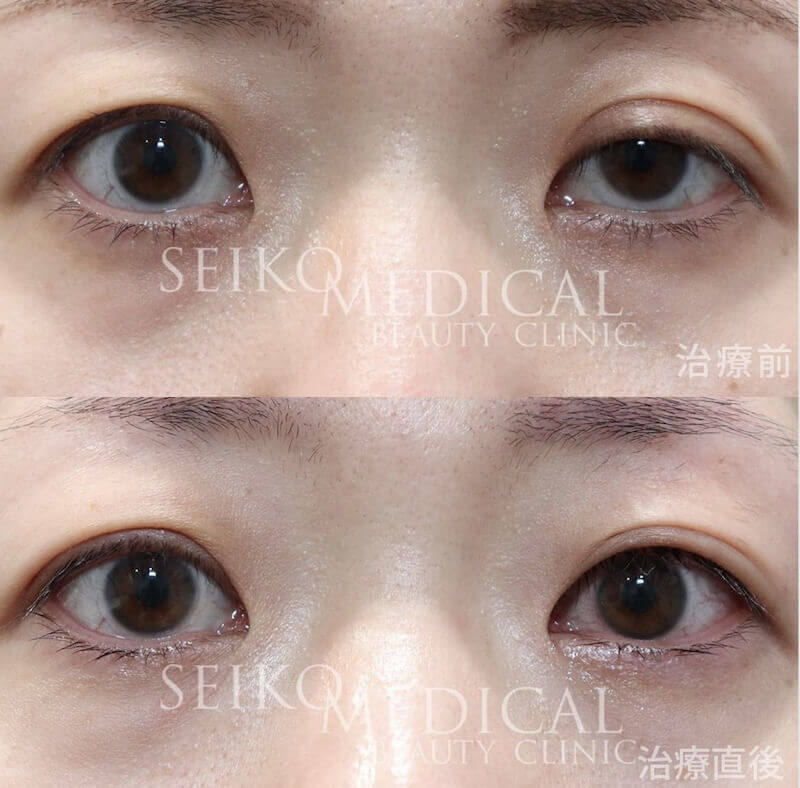 皮膚を切らずに直後から自然に目が開く【切らない眼瞼下垂】治療について