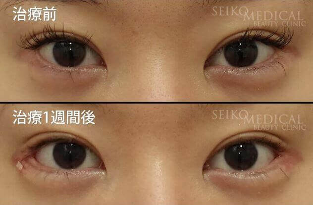 【目尻靭帯固定術、目尻切開、たれ目形成術（グラマラスライン）】1週間後までの経過