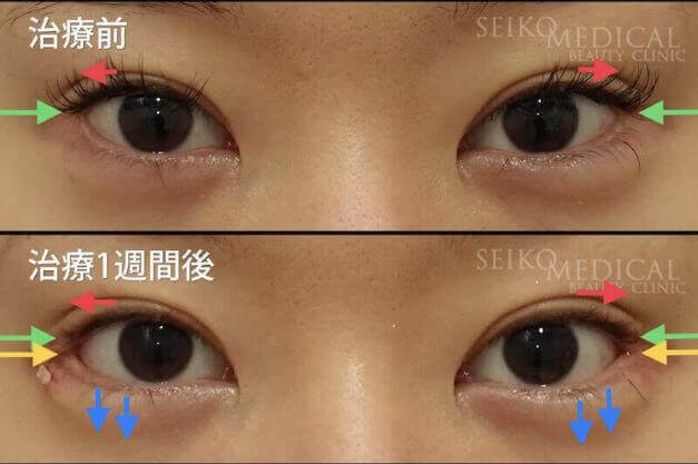 【目尻靭帯固定術、目尻切開、たれ目形成術（グラマラスライン）】1週間後までの経過