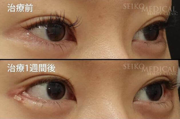 【目尻靭帯固定術、目尻切開、たれ目形成術（グラマラスライン）】1週間後までの経過