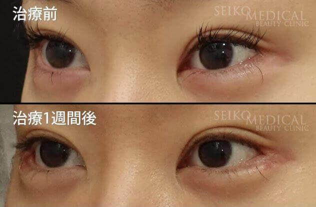 【目尻靭帯固定術、目尻切開、たれ目形成術（グラマラスライン）】1週間後までの経過