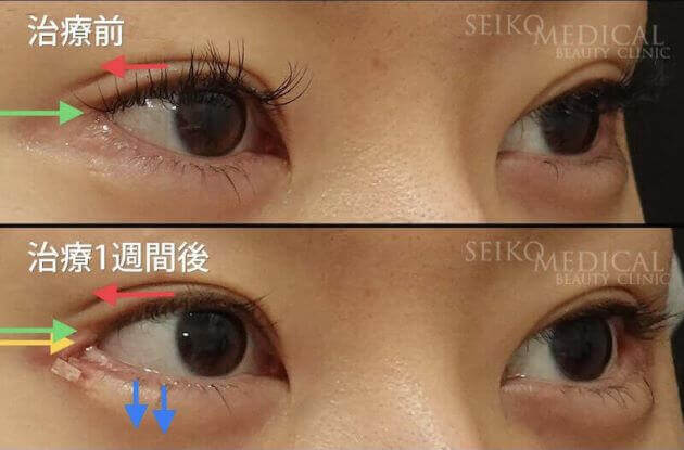 【目尻靭帯固定術、目尻切開、たれ目形成術（グラマラスライン）】1週間後までの経過