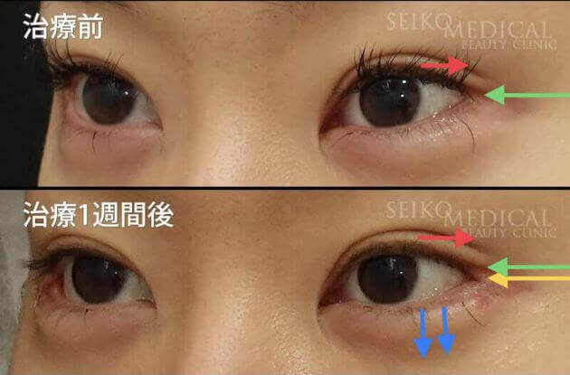 【目尻靭帯固定術、目尻切開、たれ目形成術（グラマラスライン）】1週間後までの経過