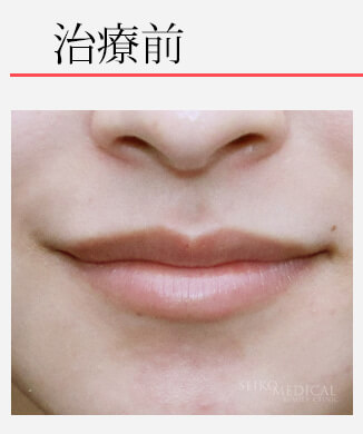【唇のヒアルロン酸注入】自然な形で、黄金比にボリュームアップしたM字リップの症例解説