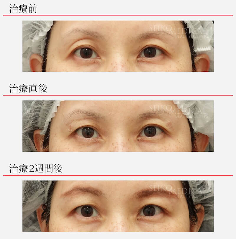 くぼみ目への凸凹しないヒアルロン酸注入、治療前→直後→２週間後の経過