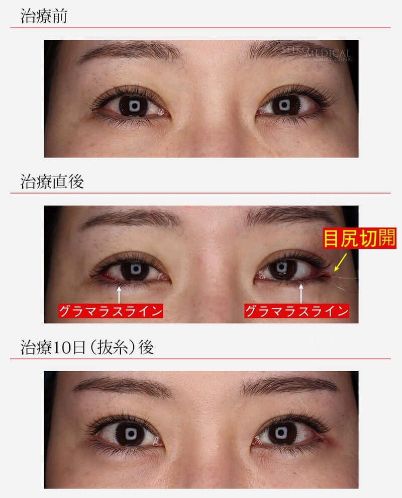 【目尻切開、切らないタレ目（グラマラスライン）】左のつり目があり左右差を整えた症例解説