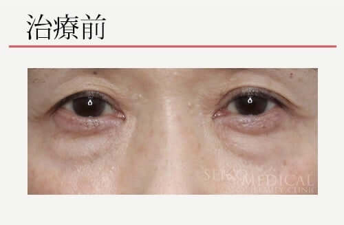 【下眼瞼のクマ、たるみ】60代女性。通常、脱脂だけでは勧められないケースの症例解説