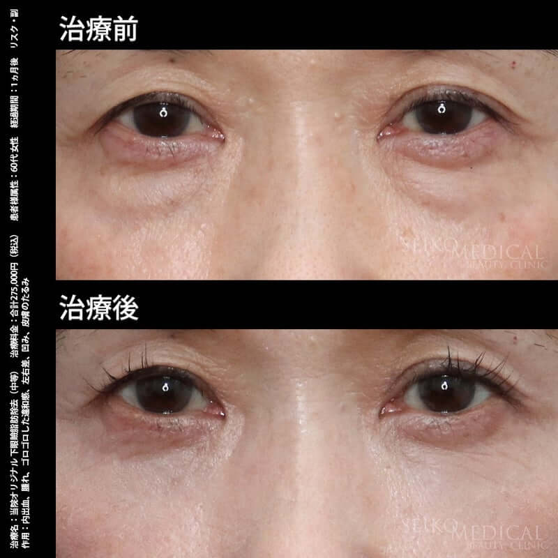 【下眼瞼のクマ、たるみ】60代女性。通常、脱脂だけでは勧められないケースの症例解説