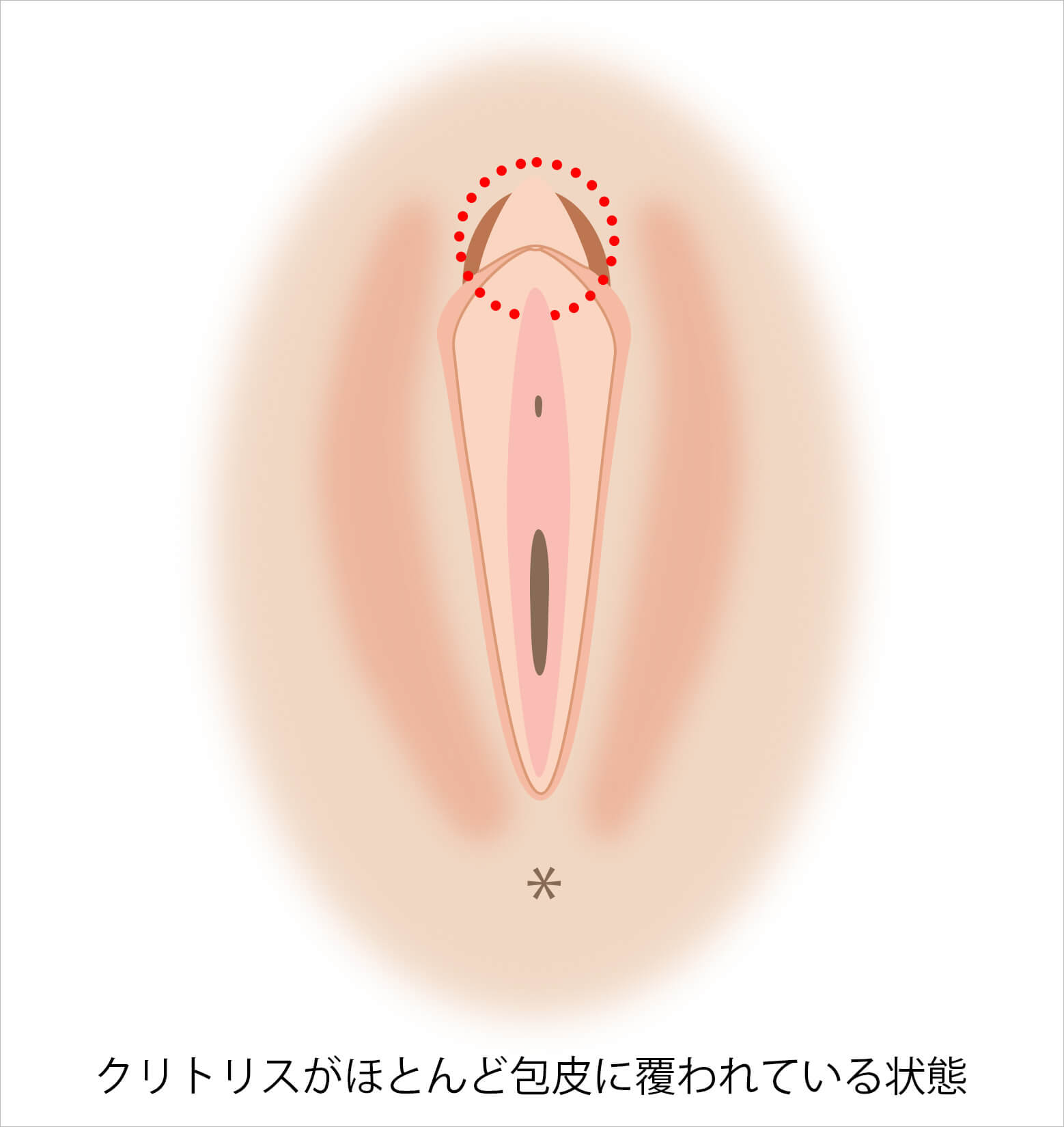 クリトリスがほとんど包皮に覆われている状態