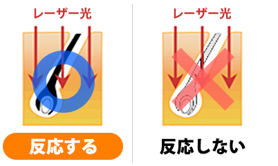 脱毛機 白髪 反応しない