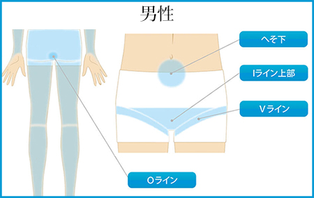 男性 脱毛 部位