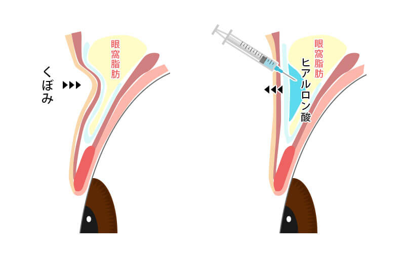 まぶたのくぼんだところへヒアルロン酸を注入