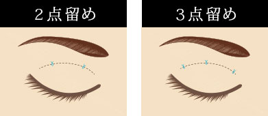 ノーマル 二重術とは?