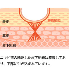 ニキビ痕の陥没した皮下組織は癒着しており、下部に引き込まれています。