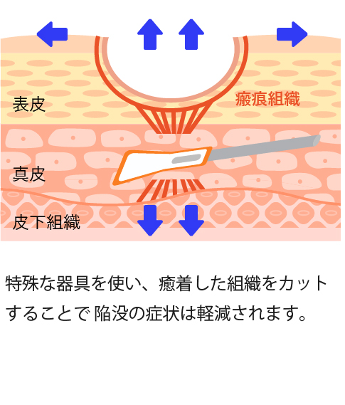 特殊な器具を使い、癒着した組織をカットすることで陥没の症状は軽減されます。