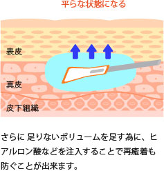 さらに、足りないボリュームを足す為に、ヒアルロン酸などを注入することで再癒着も防ぐことができます。