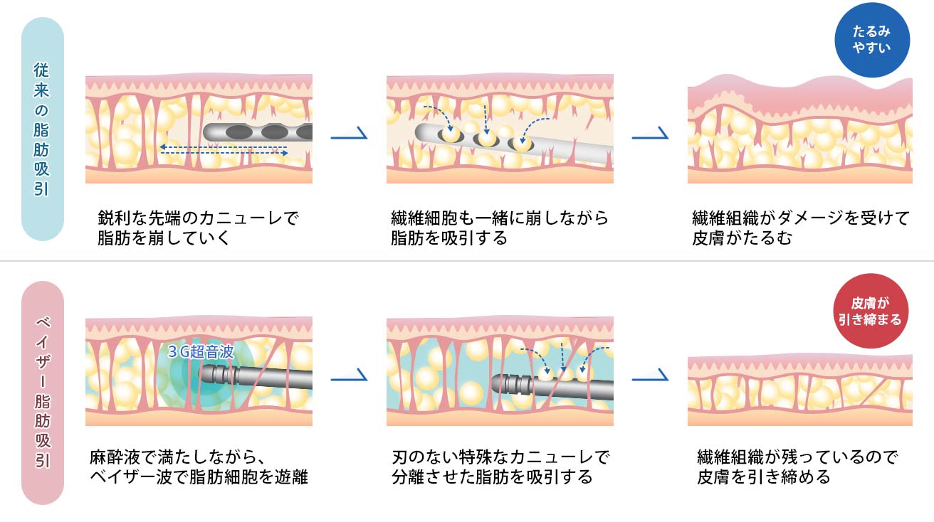 ベイザー脂肪吸引は従来の脂肪吸引と何が違うの？