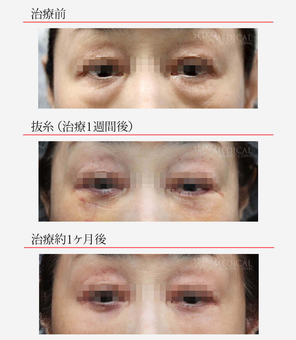 【下眼瞼のクマ、たるみ】下まぶたを切開したときの傷痕の経過