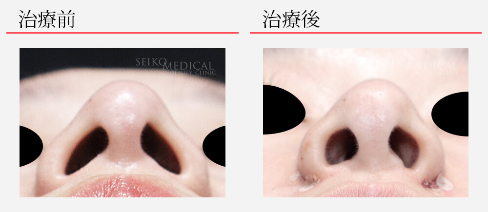 新治療！切らない小鼻（鼻翼）縮小治療の症例解説
