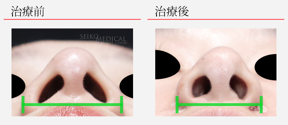 新治療！切らない小鼻（鼻翼）縮小治療の症例解説