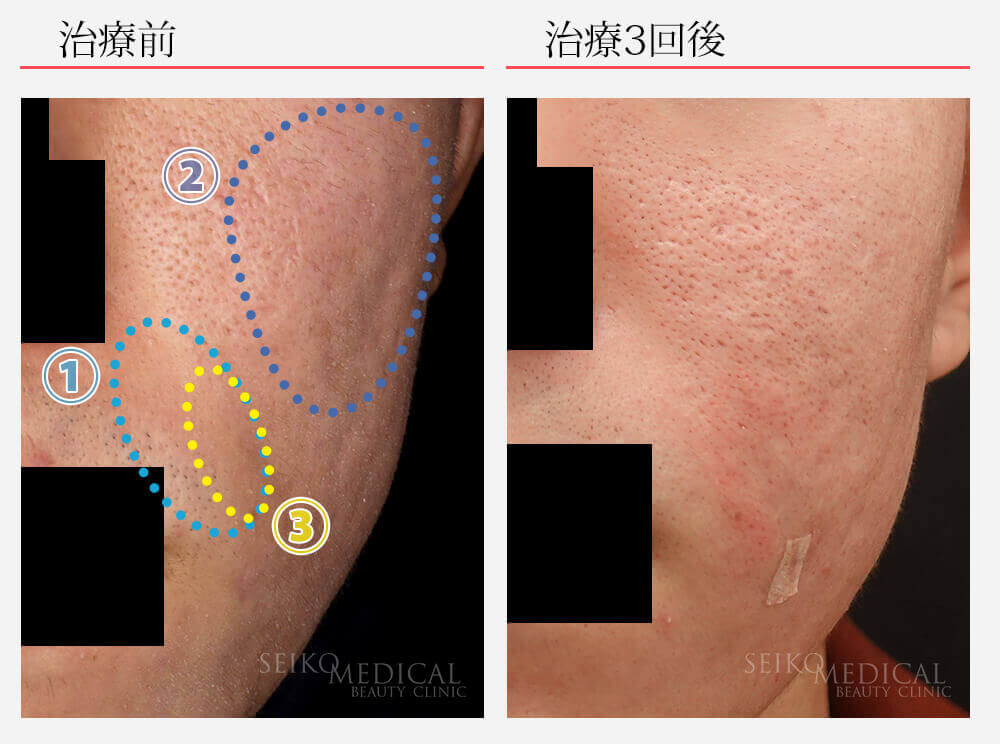 【ニキビ痕、凹み】サブシジョンの症例写真