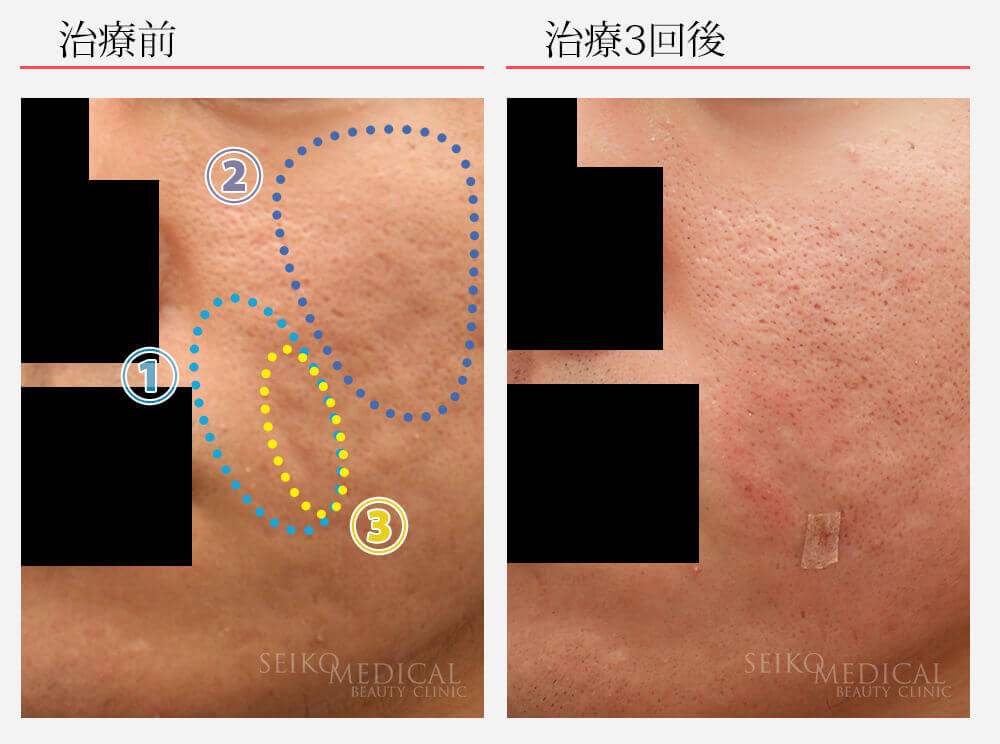 【ニキビ痕、凹み】サブシジョンの症例写真