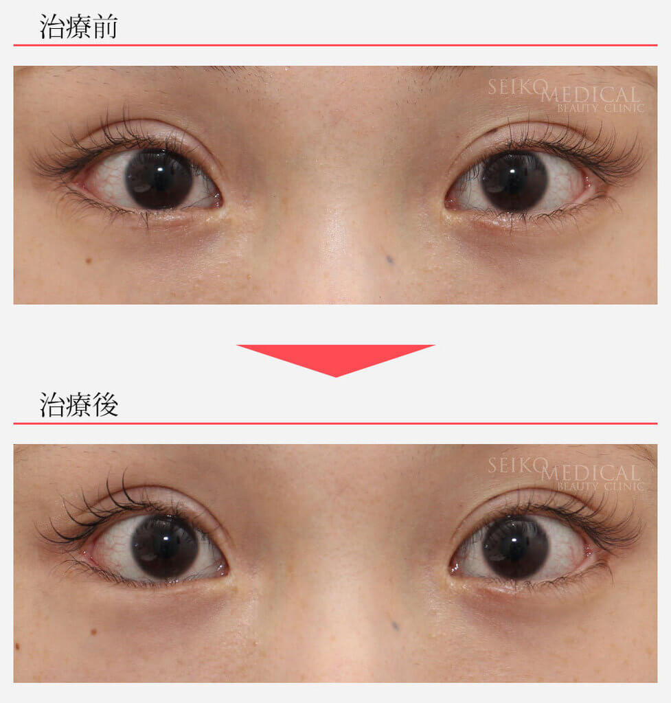 切らないたれ目形成術 片目 1点留め(右目のみ)