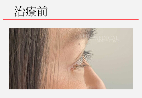 切らないたれ目形成術