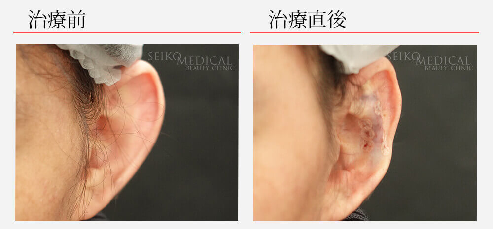 立ち耳治療 重症 片耳