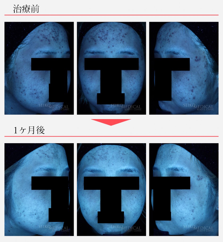 ゼオスキンヘルス症例